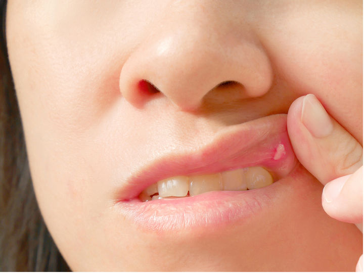 5 remedios caseros para eliminar las aftas en la boca - Salud180 (blog)