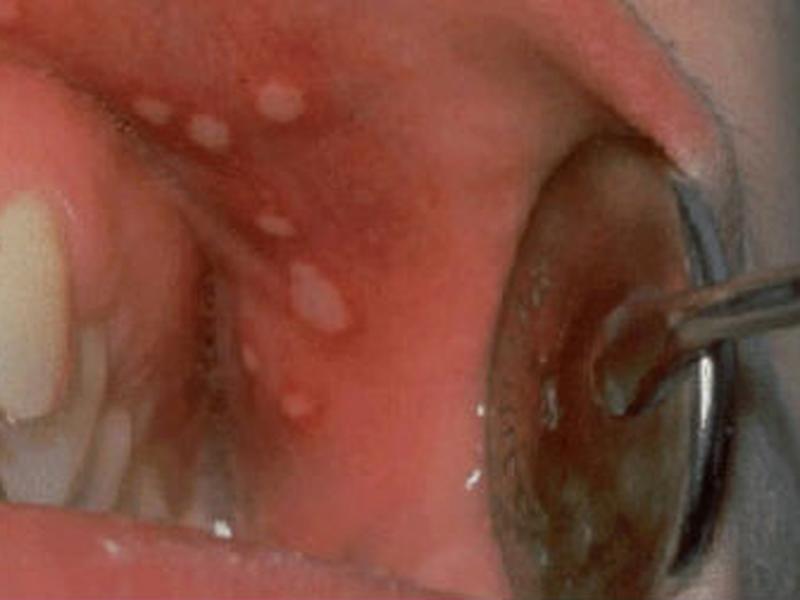 El herpes oral puede aparecer en los labios, encías, garganta y cara