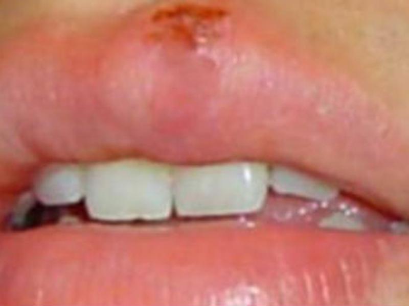 El herpes labial es una infección que aunque se puede controlar, no se cura