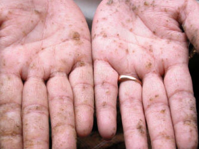 El arsénico provoca afectaciones en las palmas de las manos.