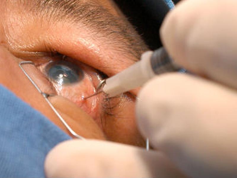 Entre las enfermedades más serias en los ojos están la catarata, glaucoma y retinopatía diabética.