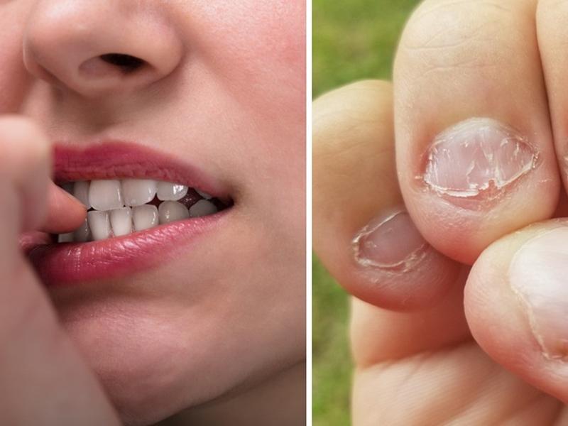 Mujer con uñas deformes por morderlas