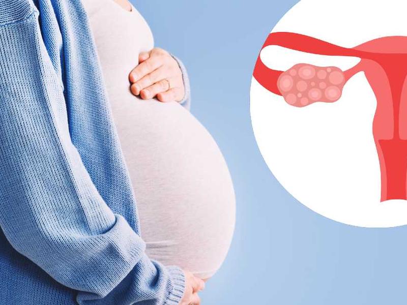 mujer embarazada e ilustración de síndrome de ovario poliquístico