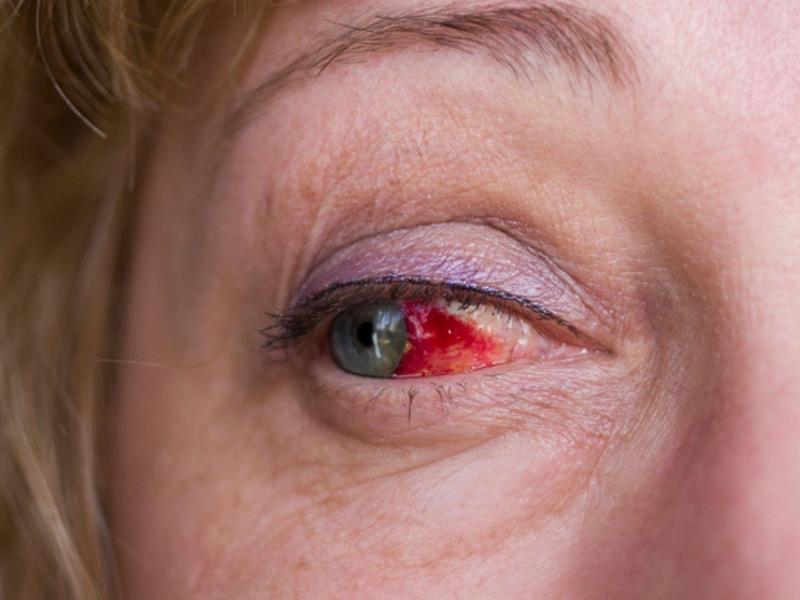 Mujer con ojo rojo como un derrame ocular.