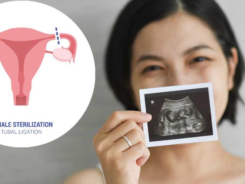 Ilustración ligadura de trompas de Falopio/ Mujer mostrando ultrasonido de embarazo