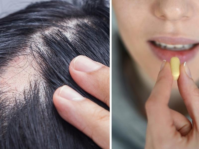 Pérdida de cabello por alopecia mujer con tratamiento