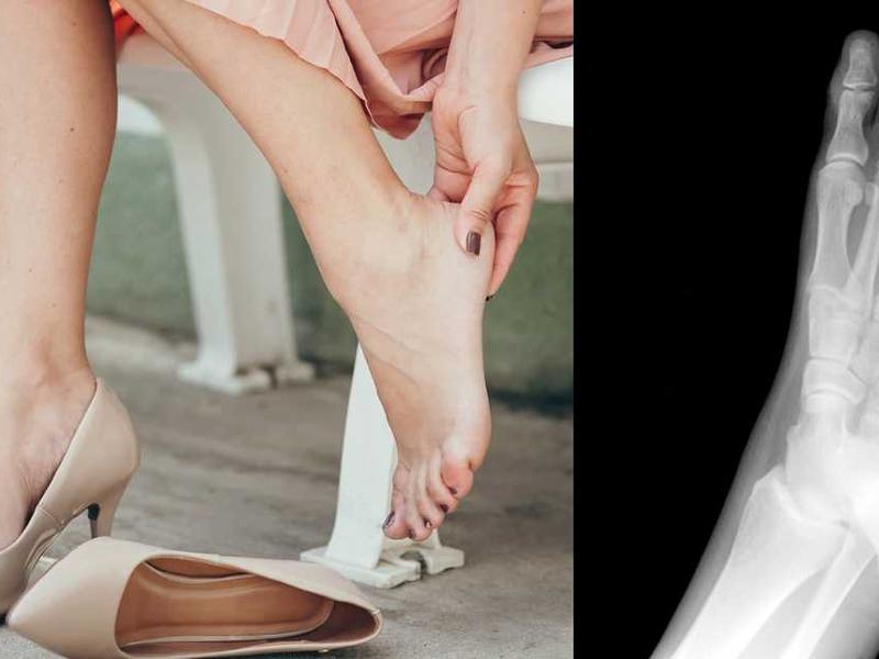 Mujer con dolor de pie por tacones / radiografía pie
