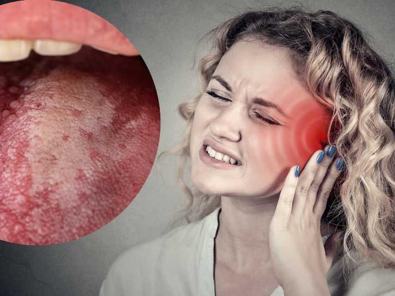 Lesión en la lengua asociada a cáncer / mujer con dolor de oído