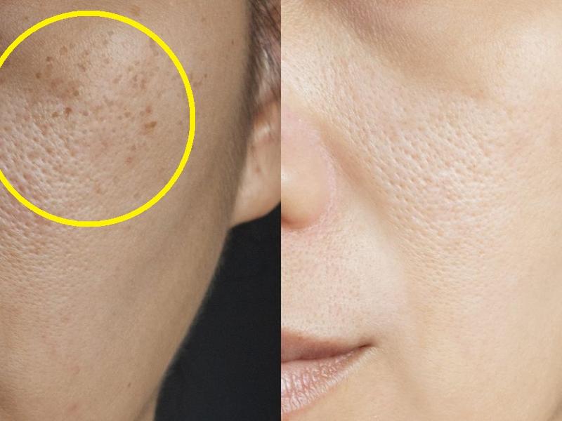 Mujer con manchas en la piel por sol antes y después