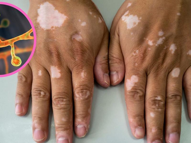Manos con manchas blancas en la piel por causa de hongos