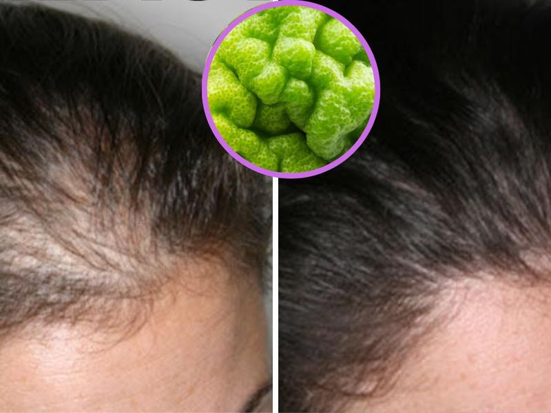 Un antes y después de utilizar aceite de bergamota para evitar la caída de pelo y cubrir las entradas del cabello 