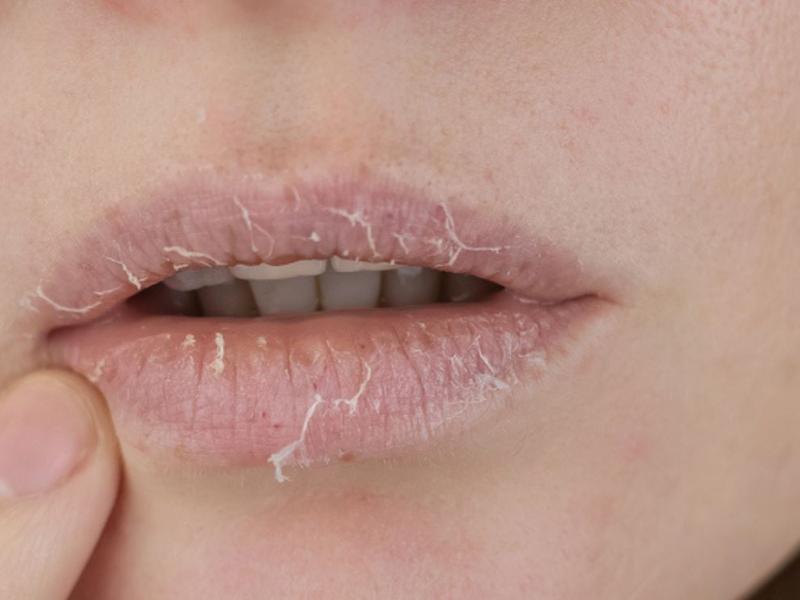 Mujer con boca seca por el síndrome de Sjögren