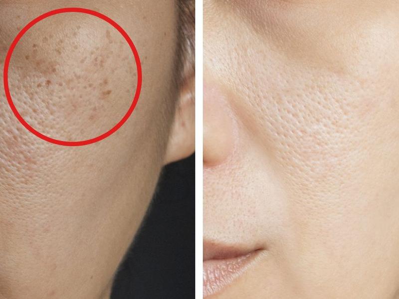 Mujer con manchas en la piel antes y después