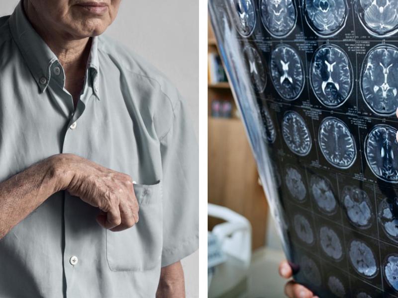 Hombre con brazo entumido, tomografía para explicar los signos poco comunes de convulsiones que esconden una epilepsia