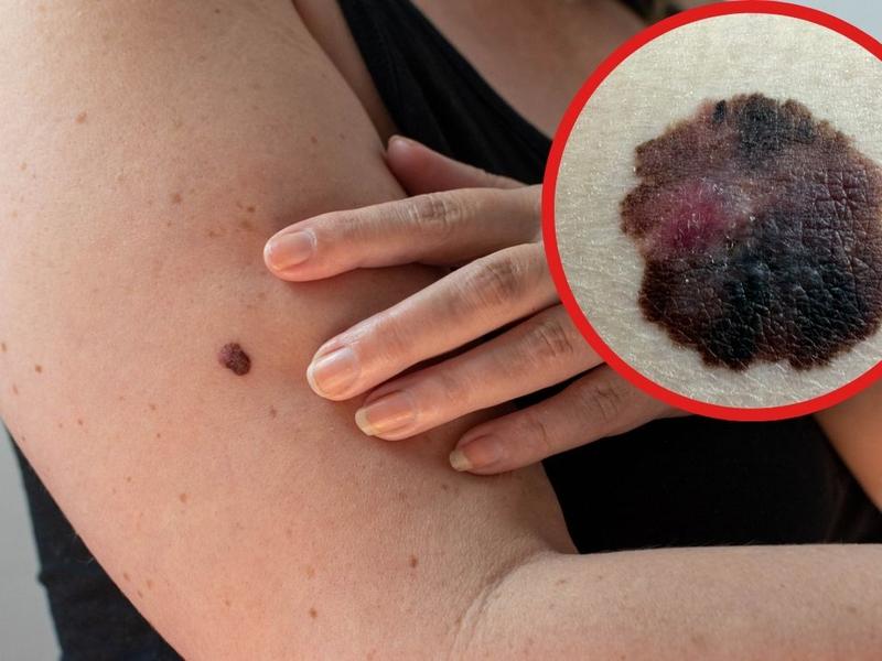 Mujer lunar con cáncer de piel 