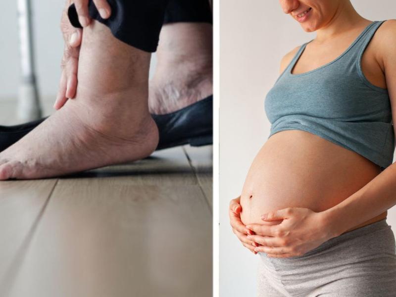 Persona con pies hinchados, mujer embarazada para explicar por qué los pies crecen con el embarazo