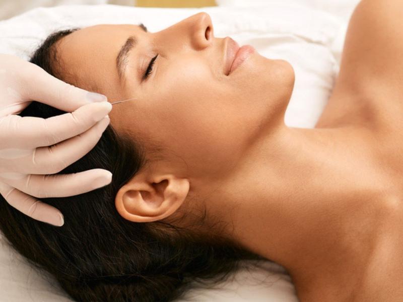 Mujer recibiendo acupuntura facial porque conoce los beneficios