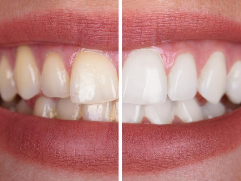 Mujer con sarro en los dientes antes y depués