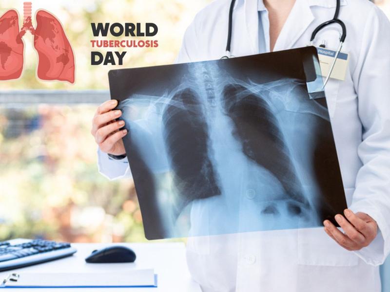 Médico sosteniendo radiografía pulmonar para explicar el día mundial contra la tuberculosis