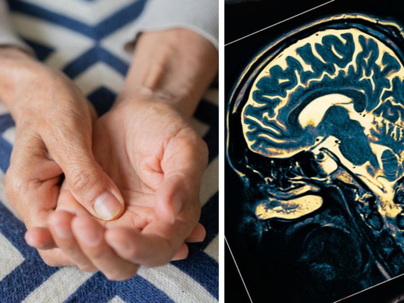 Persona sosteniendo su mano, tomografía para explicar qué es el Parkinson