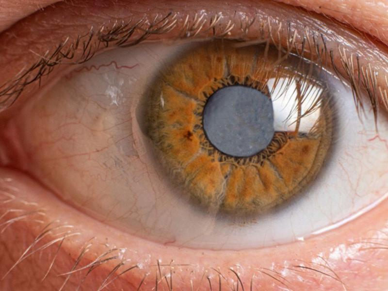 Persona con glaucoma