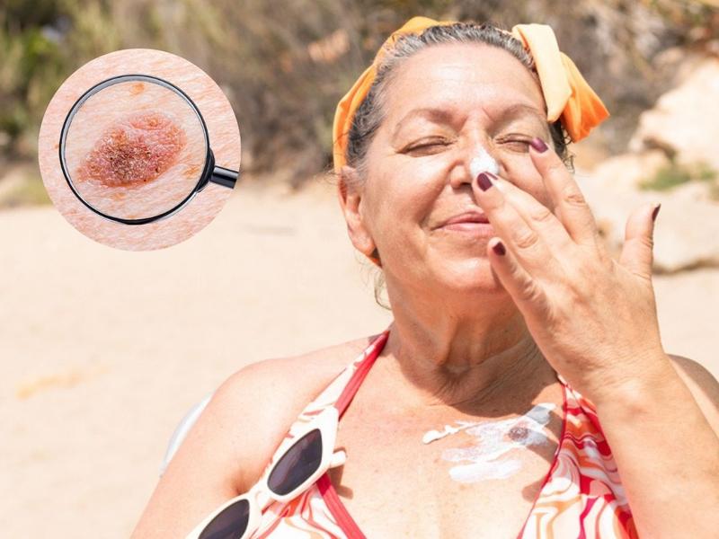 Mujer con bloqueador en la cara para ilustrar que Mujer pierde punta de nariz por cáncer detectado gracias a dentista