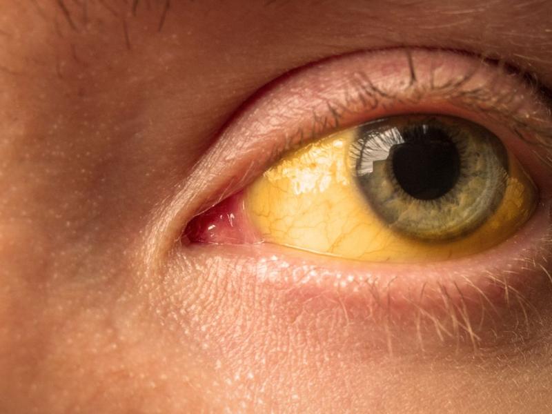 Persona con los ojos amarillos síntoma del virus de hepatitis