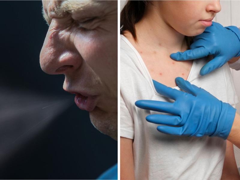 Hombre estornuda sin taparse la boca mujer contagiada de sarampión