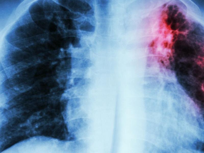 Radiografía de neumonía pulmones.