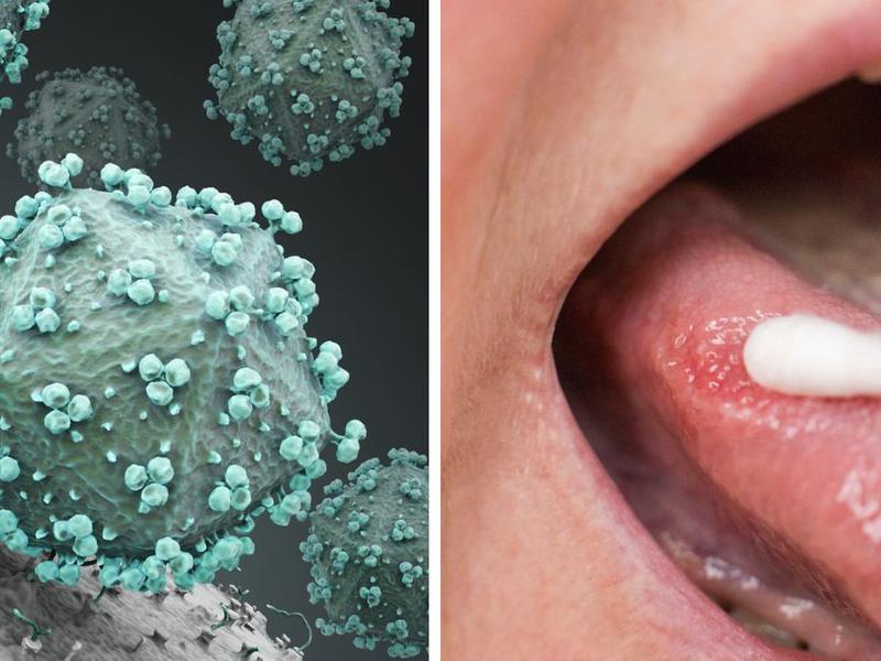 Virus de VIH persona con una lesión en la lengua 