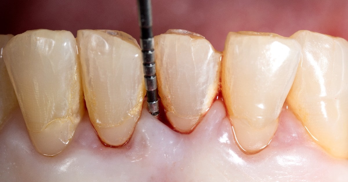 Revisión dental a causa de periodontitis.
