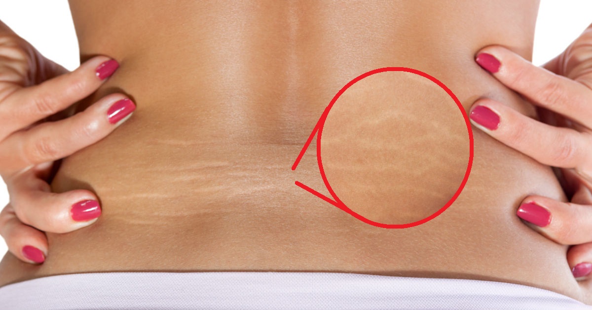 Olvídate de las “marcas de tigre” porque los ácidos grasos del aceite de mosqueta son capaces de regenerar la piel 