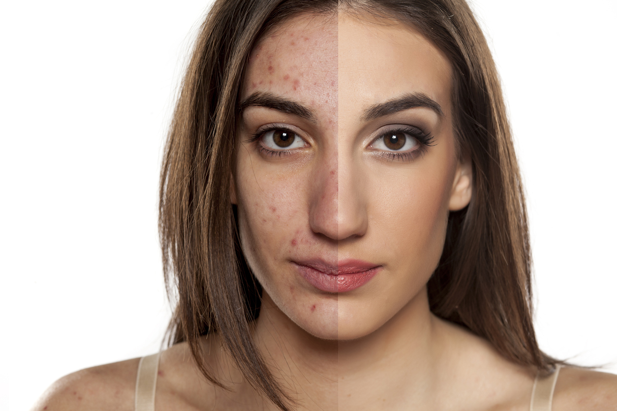 ¿Cuál es tu tipo de acné? Descúbrelo y elimínalo sin falla