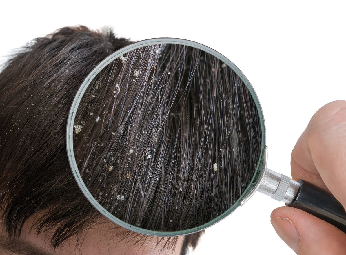 La partículas PM2.5 se depositan en tu cuero cabelludo y provocan estrés oxidativo generando caspa