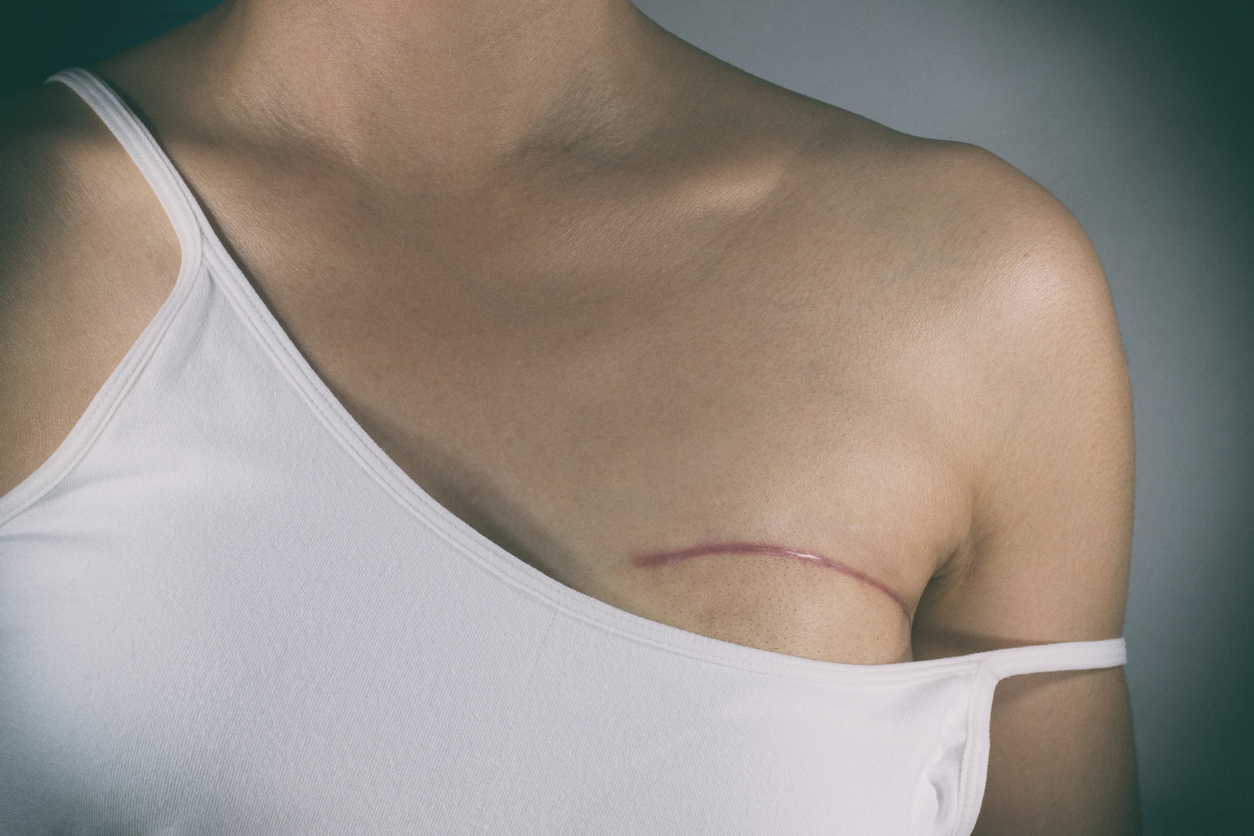 Cáncer de mama: la importancia de conocer nuestro cuerpo para salvar la vida