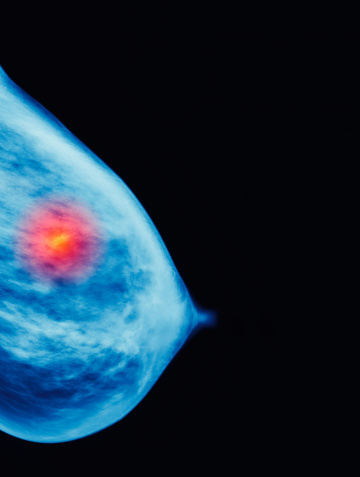 Cáncer de mama: la importancia de conocer nuestro cuerpo para salvar la vida
