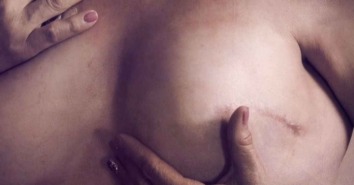 Enfrentarse a la mastectomía para ganarle la batalla al cáncer de mama 