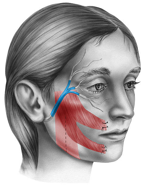 Lesión grave del nervio facial por bichectomía