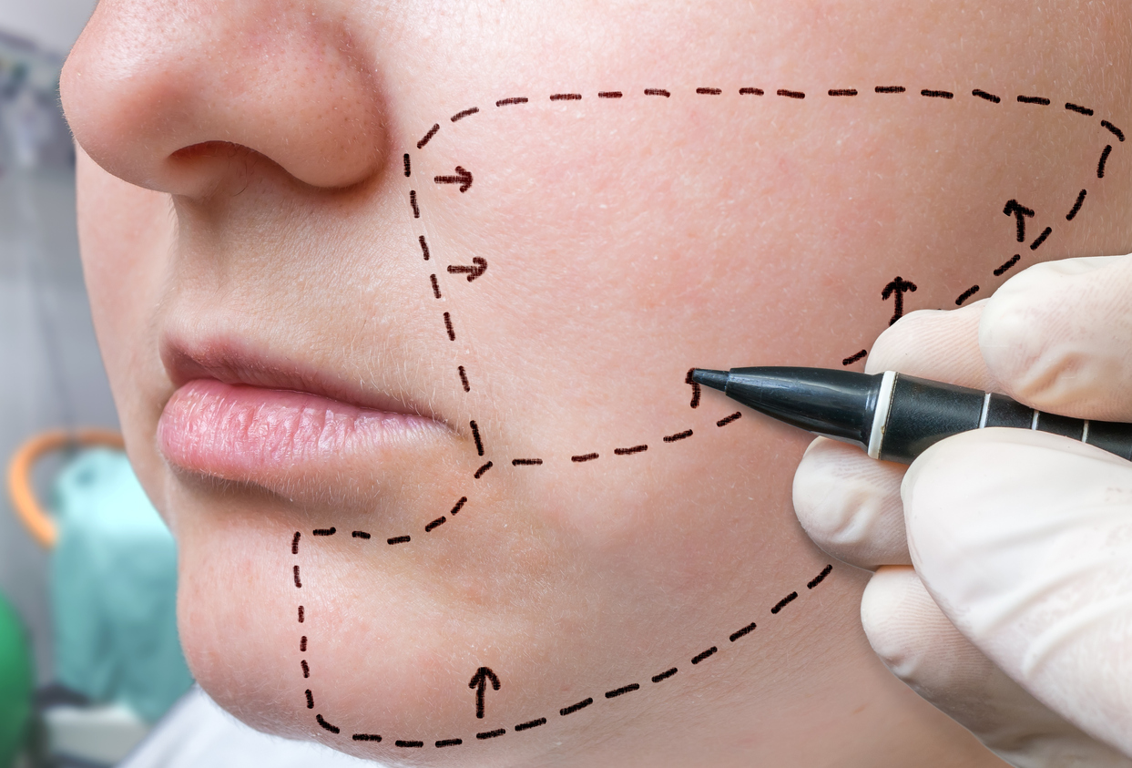  Lipofilling o lipoinyección facial para corregir bichectomía