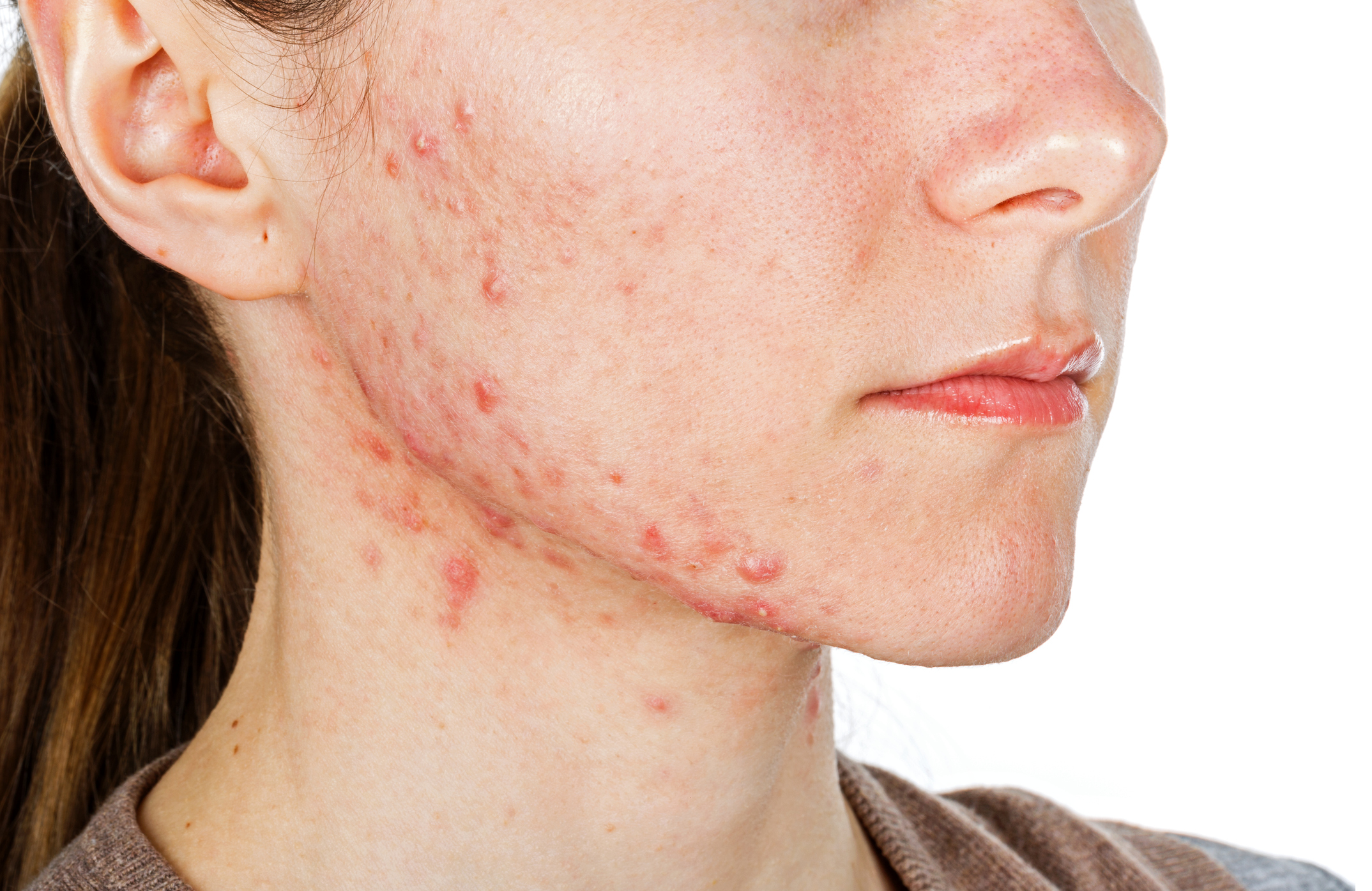 Cómo eliminar las cicatrices profundas del acné