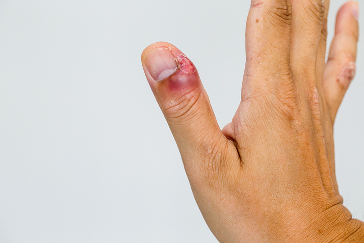 Infección en la piel del dedo por comerse las uñas