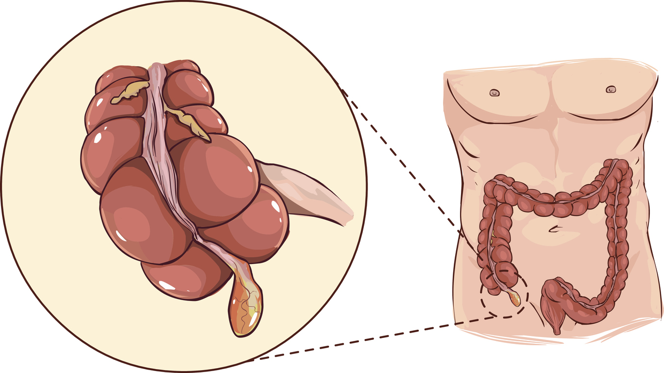 Síntomas de apendicitis