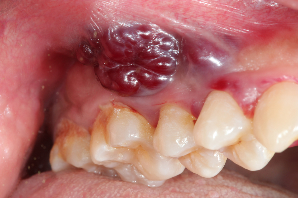 Protuberancia dentro de la boca señal de cáncer oral