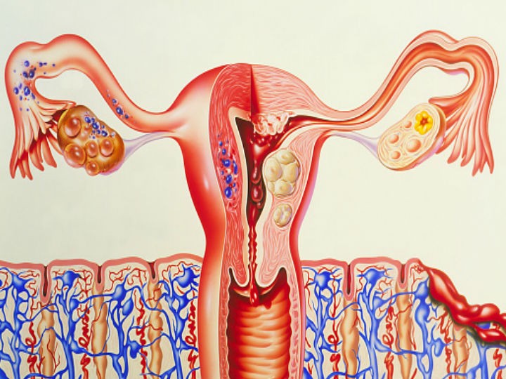 Dolor de espalda: señal inequívoca de cáncer de ovario