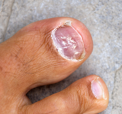 Cómo curar los hongos de las uñas de los pies ¿Ayuda el vinagre?