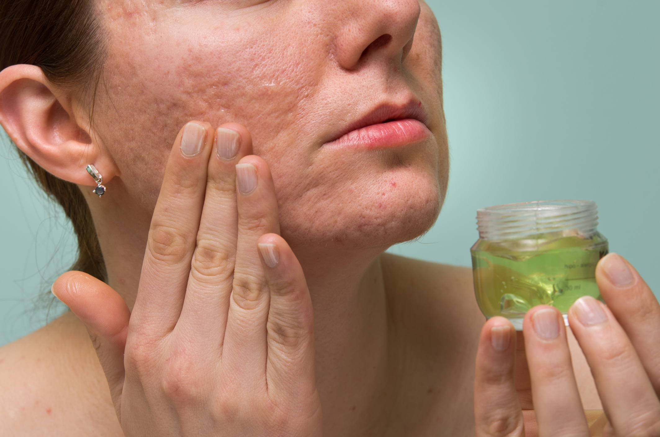 Cómo eliminar las cicatrices profundas del acné
