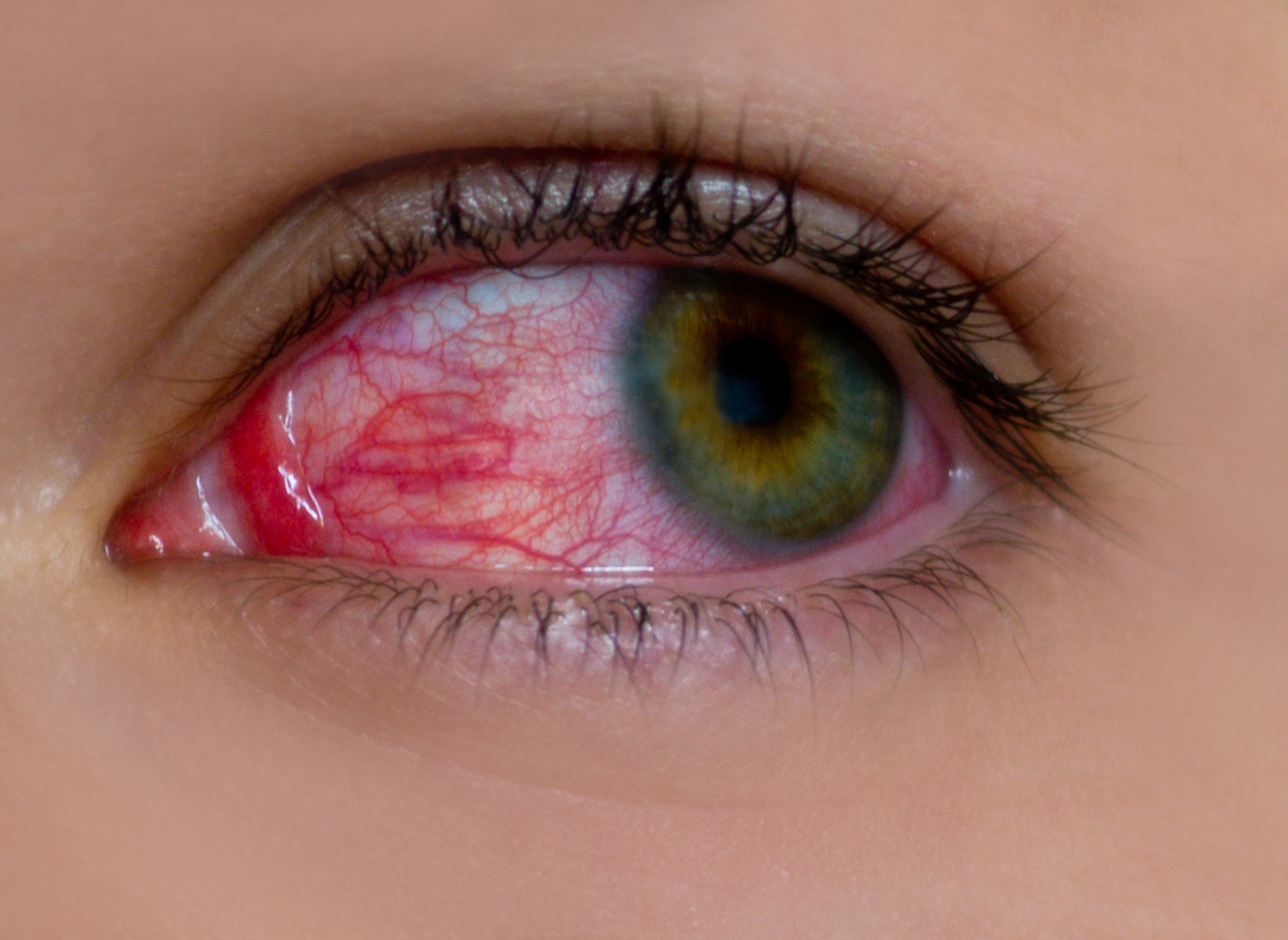 La sífilis ocular es una complicación que puede aparecer en la etapa temprana de esta ETS 