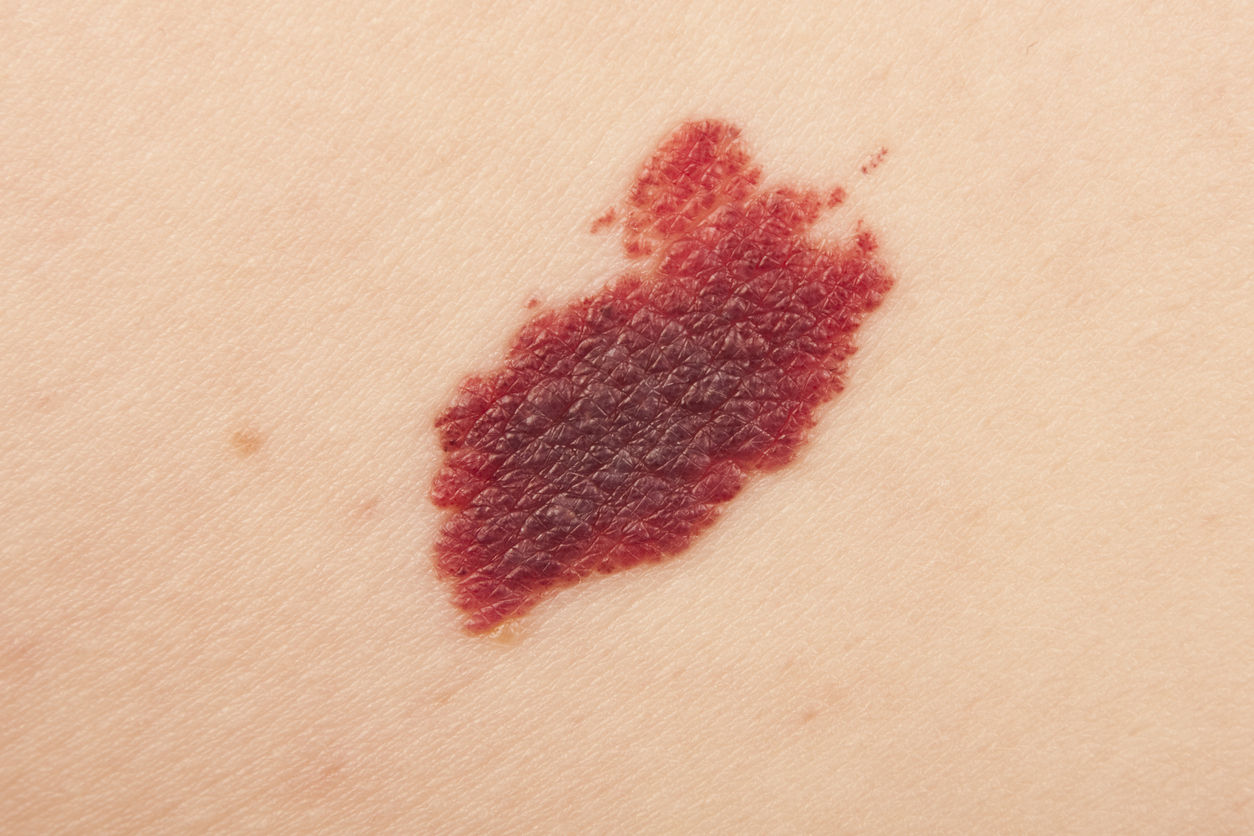 El abuso de estos productos puede disparar la probabilidad de padecer cáncer de piel