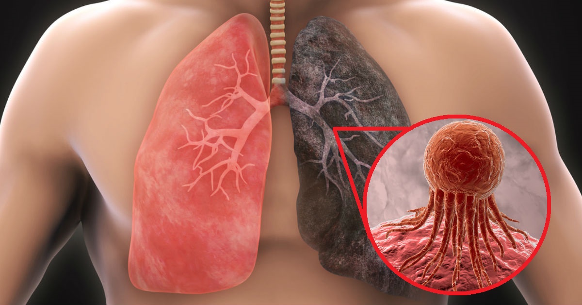 4 complicaciones que puedes tener si vives con cáncer de pulmón