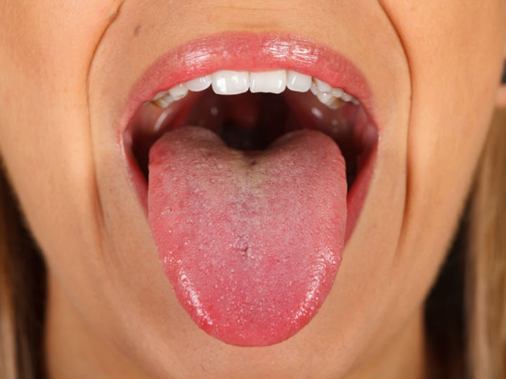 Papiloma de boca en boca